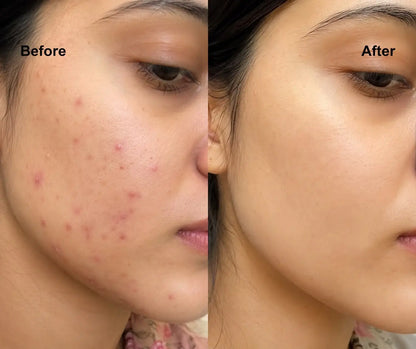 Anti Acne Facewash